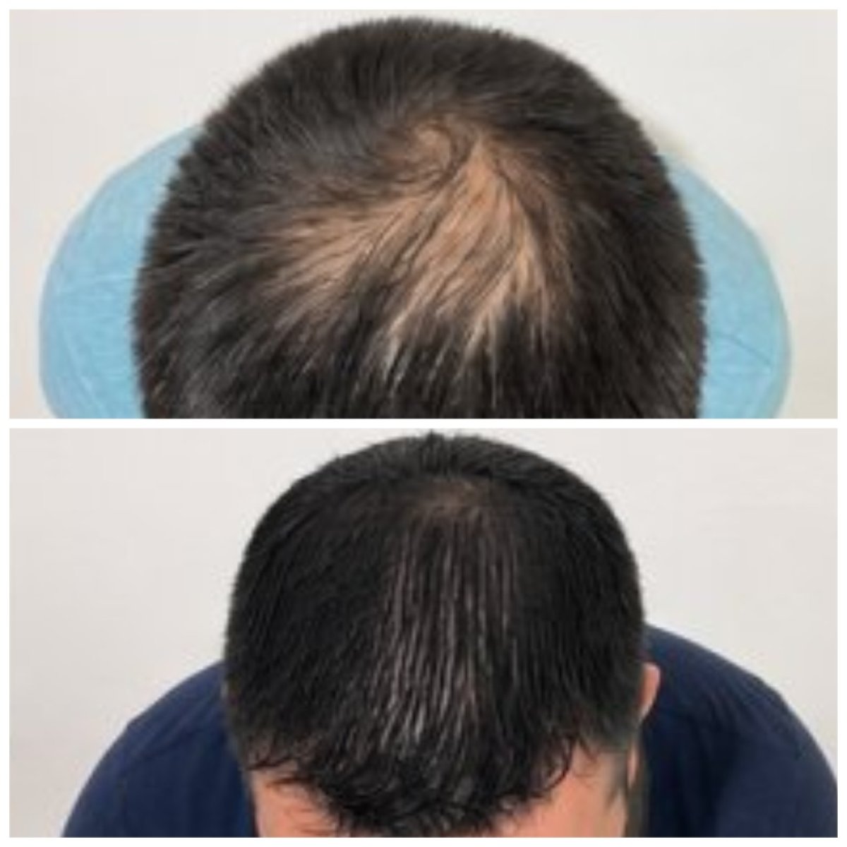 Antes y después de restauración capilar con células madre donantes en CellsClinic