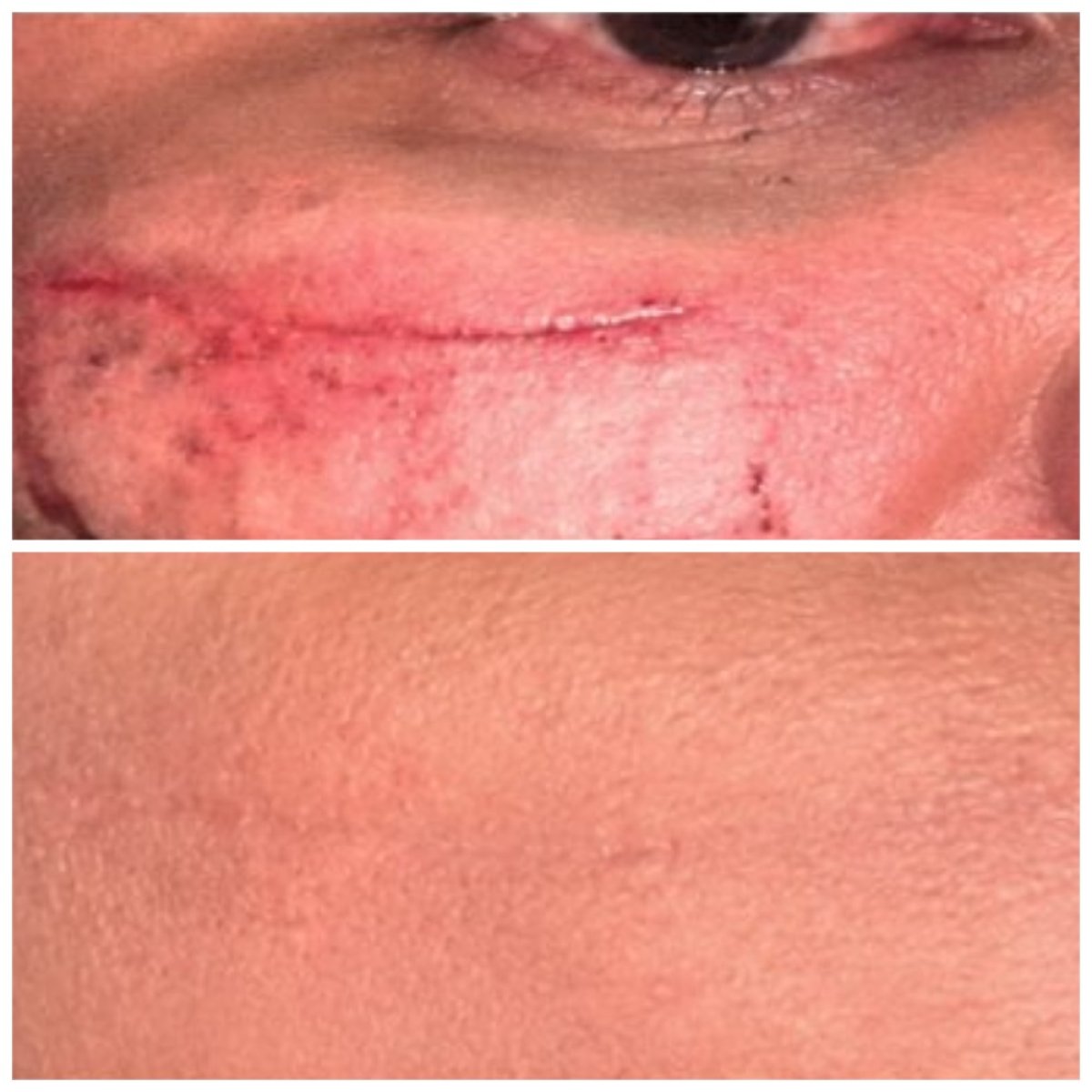 Resultados de reducción de cicatrices tras terapia con exosomas en CellsClinic Regenerative