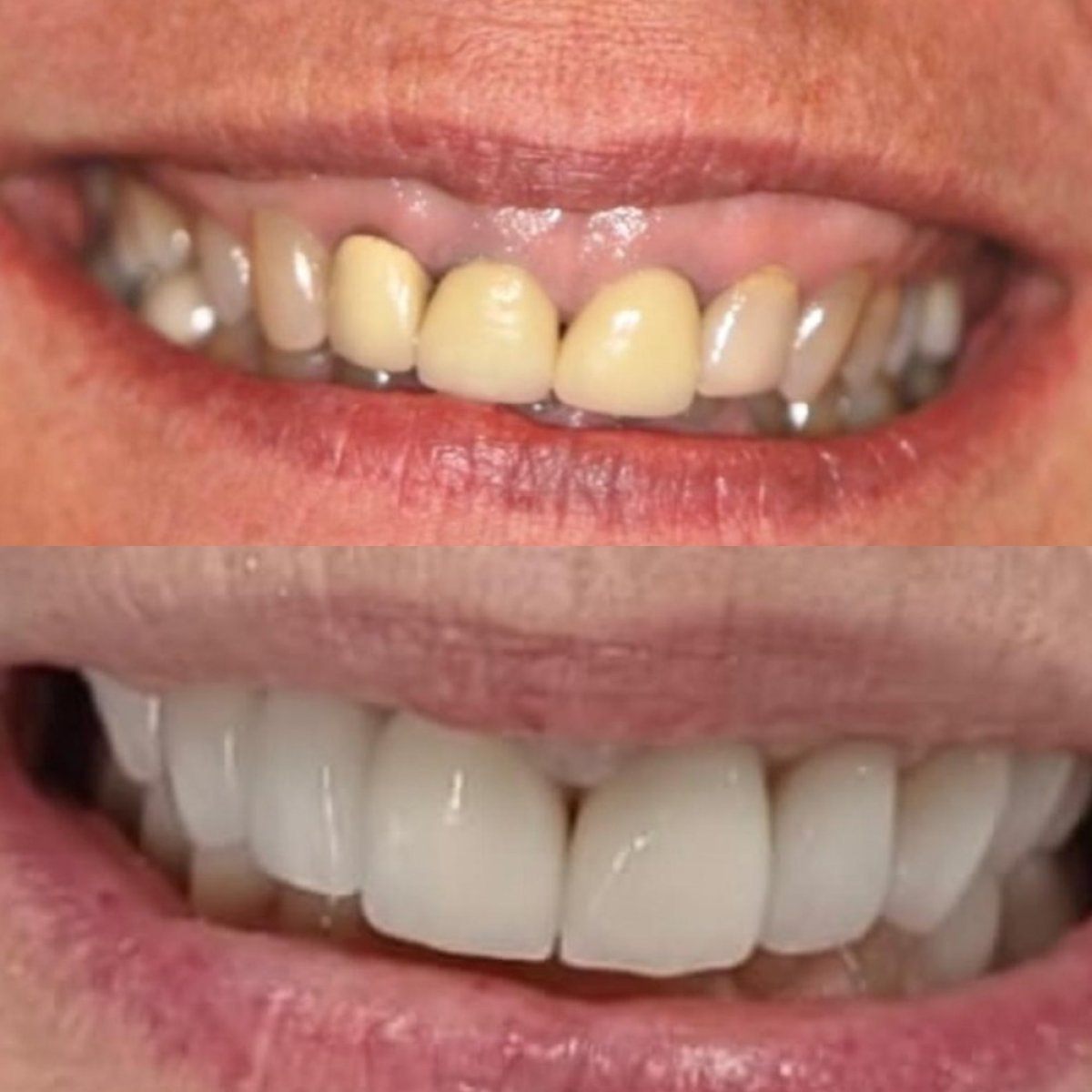 قبل وبعد الفينير في Clínica Zago Dental Clinic – نتيجة تحول الابتسامة