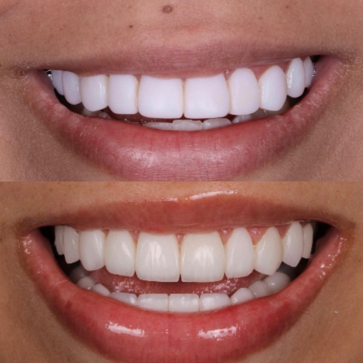 Résultat avant-après facettes dentaires à Clínica Zago Dental Clinic – sourire amélioré