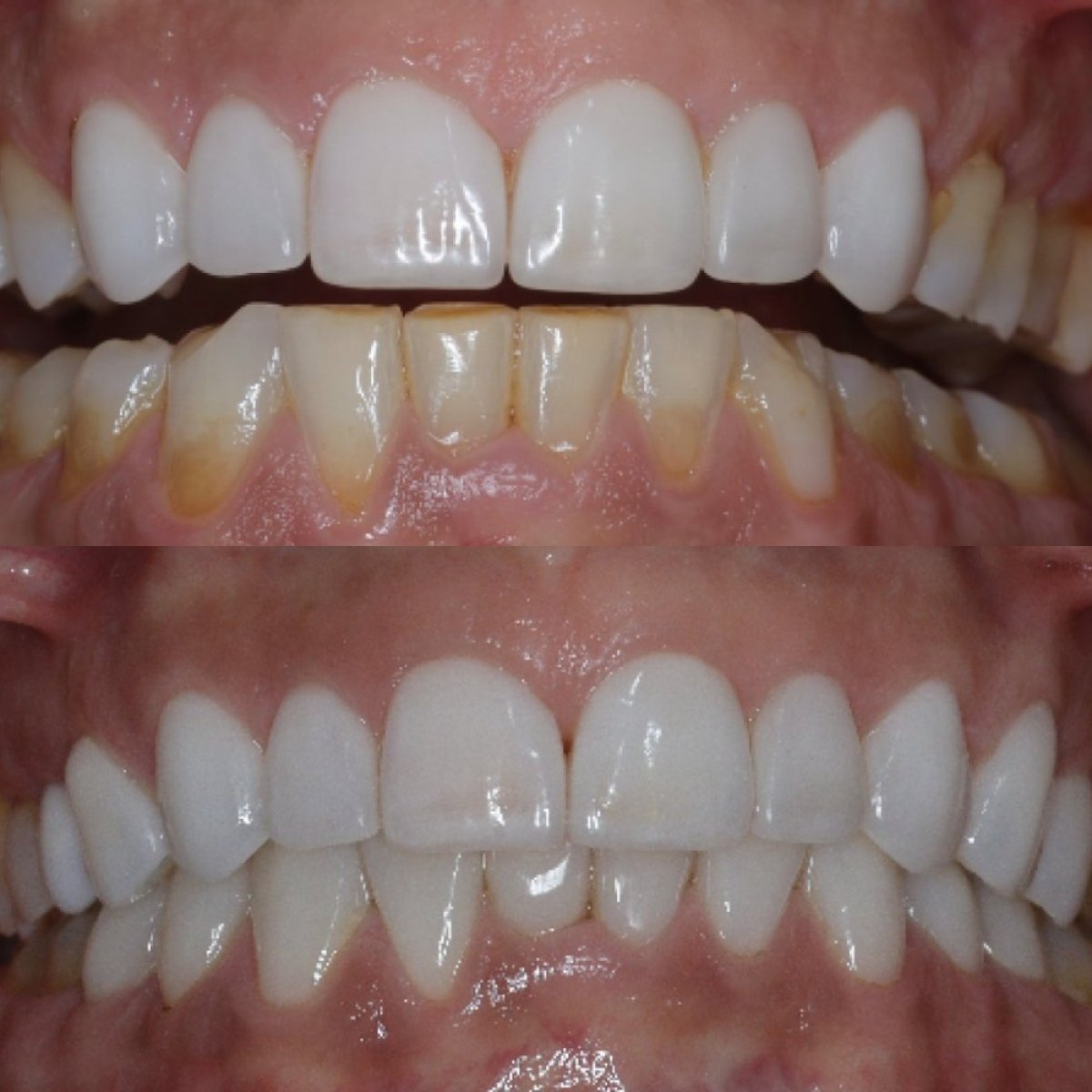 قبل وبعد الفينير في Clínica Zago Dental Clinic، نتيجة تحول الابتسامة