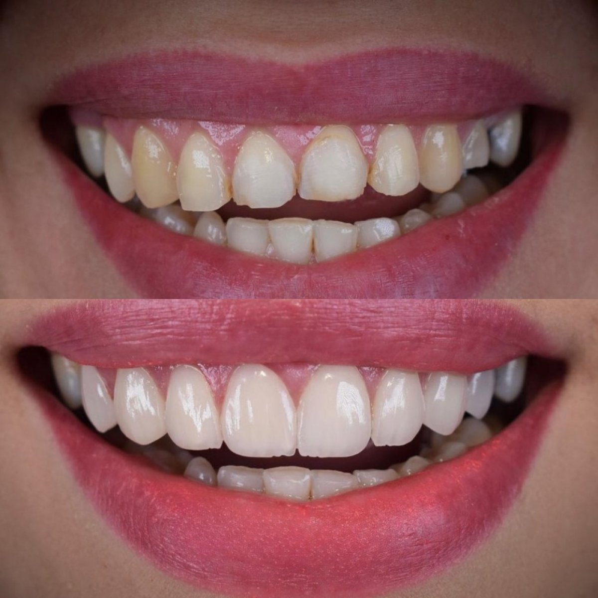 Before and after veneers result – smile makeover with whiter, even teeth