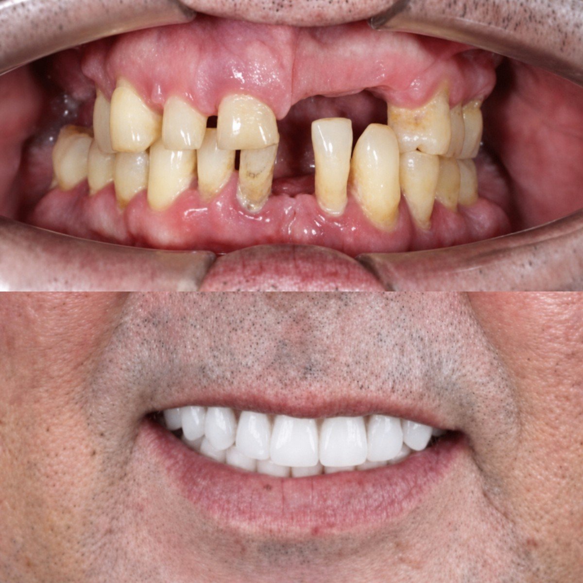 نتيجة قبل وبعد زراعة الأسنان All-on-6 في SmileBox Dental Clinic - Thonglor, Sukhumvit