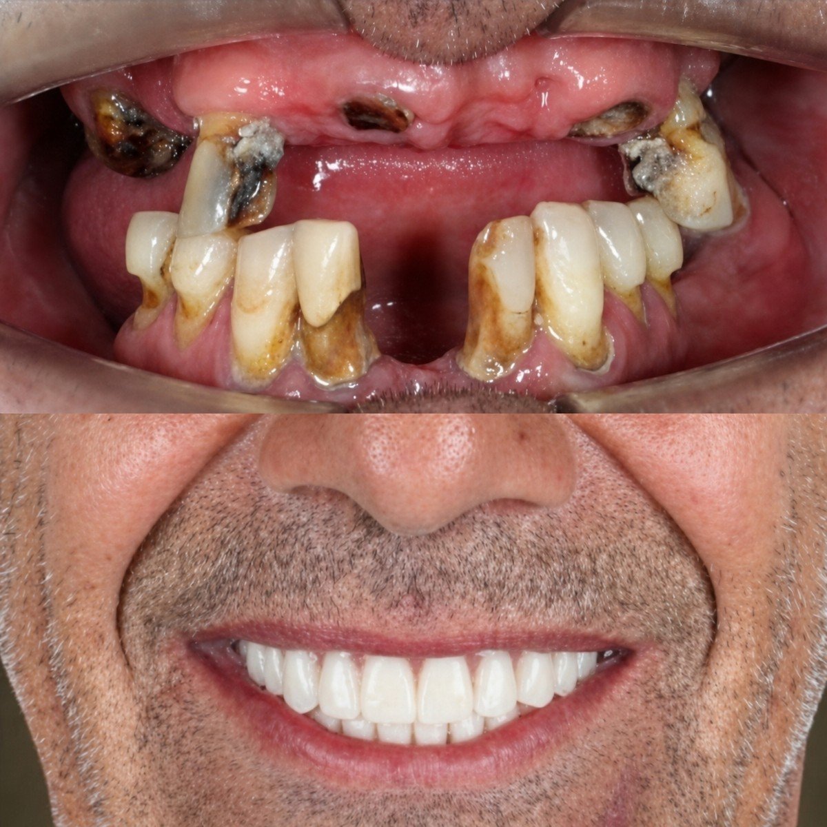 Результат до и после имплантации All-on-6 в SmileBox Dental Clinic - Thonglor, Sukhumvit