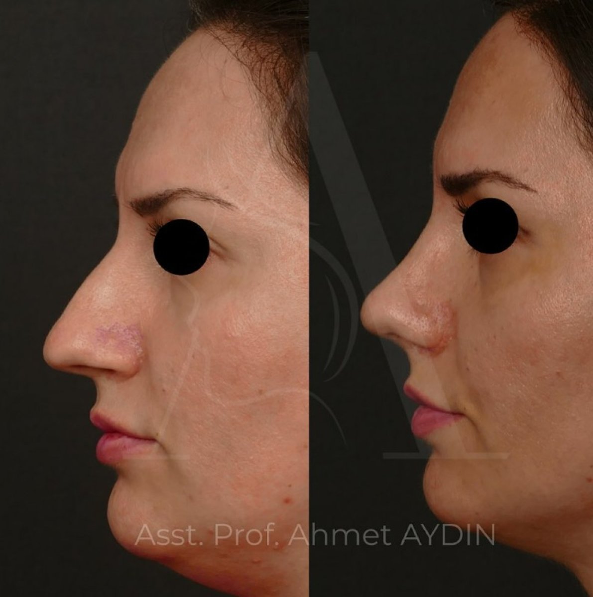 Resultados de rinoplastia antes y después por Dr. Ahmet Aydin, perfil nasal natural