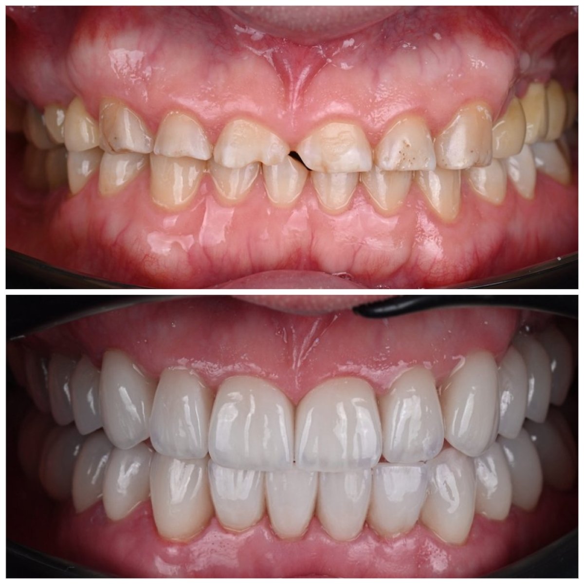 نتائج قبل وبعد قشور الأسنان في YAREMA DENTAL – ابتسامة طبيعية وجذابة
