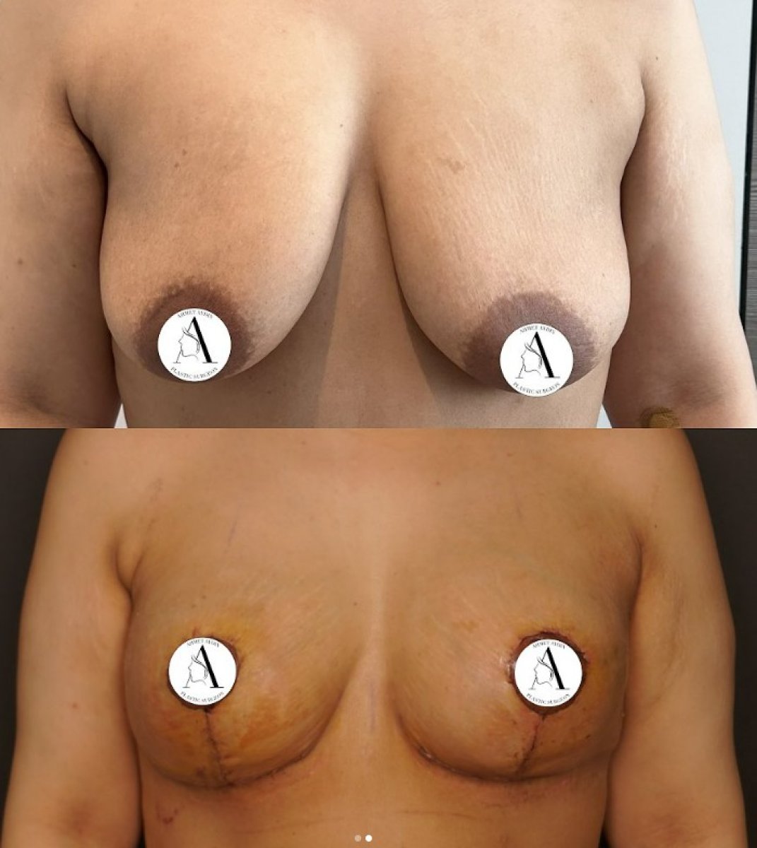 Resultados de lifting de senos antes y después en clínica de cirugía estética – mejor contorno