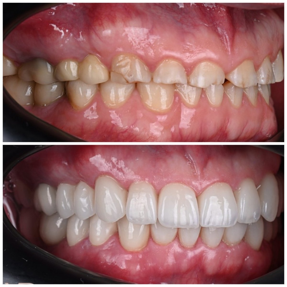 نتائج قبل وبعد الفينير في YAREMA DENTAL – تحول الابتسامة بمظهر طبيعي