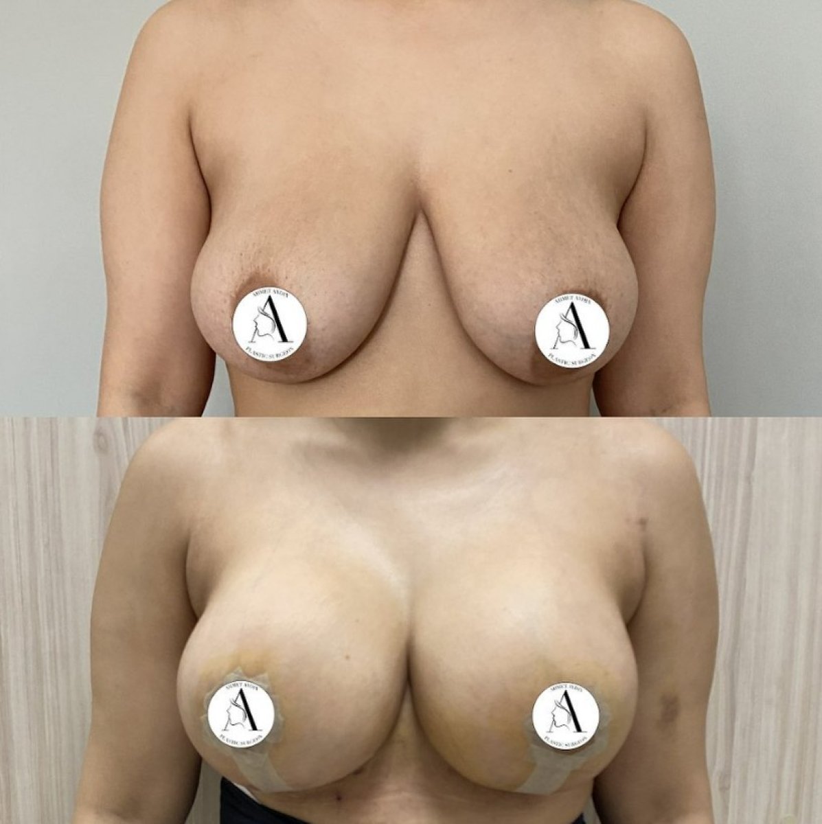 نتائج قبل وبعد تكبير ورفع الثدي في Aesthetic Clinic – ثدي ممتلئ ومرفوع