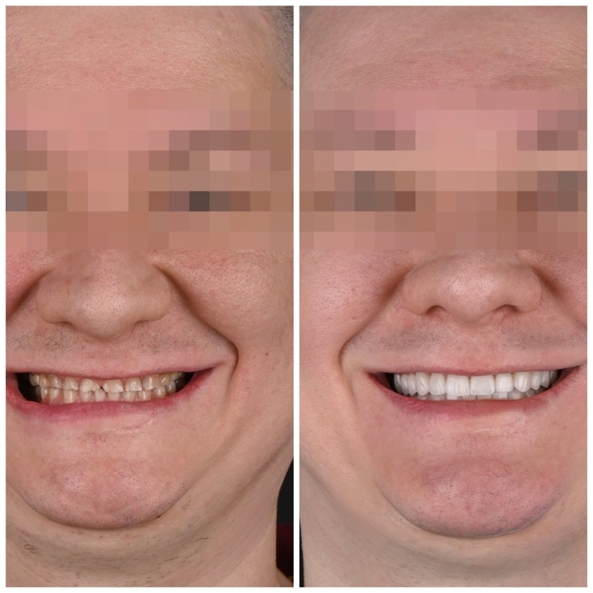 نتائج قبل وبعد الفينير في YAREMA DENTAL – تحول الابتسامة بمظهر طبيعي