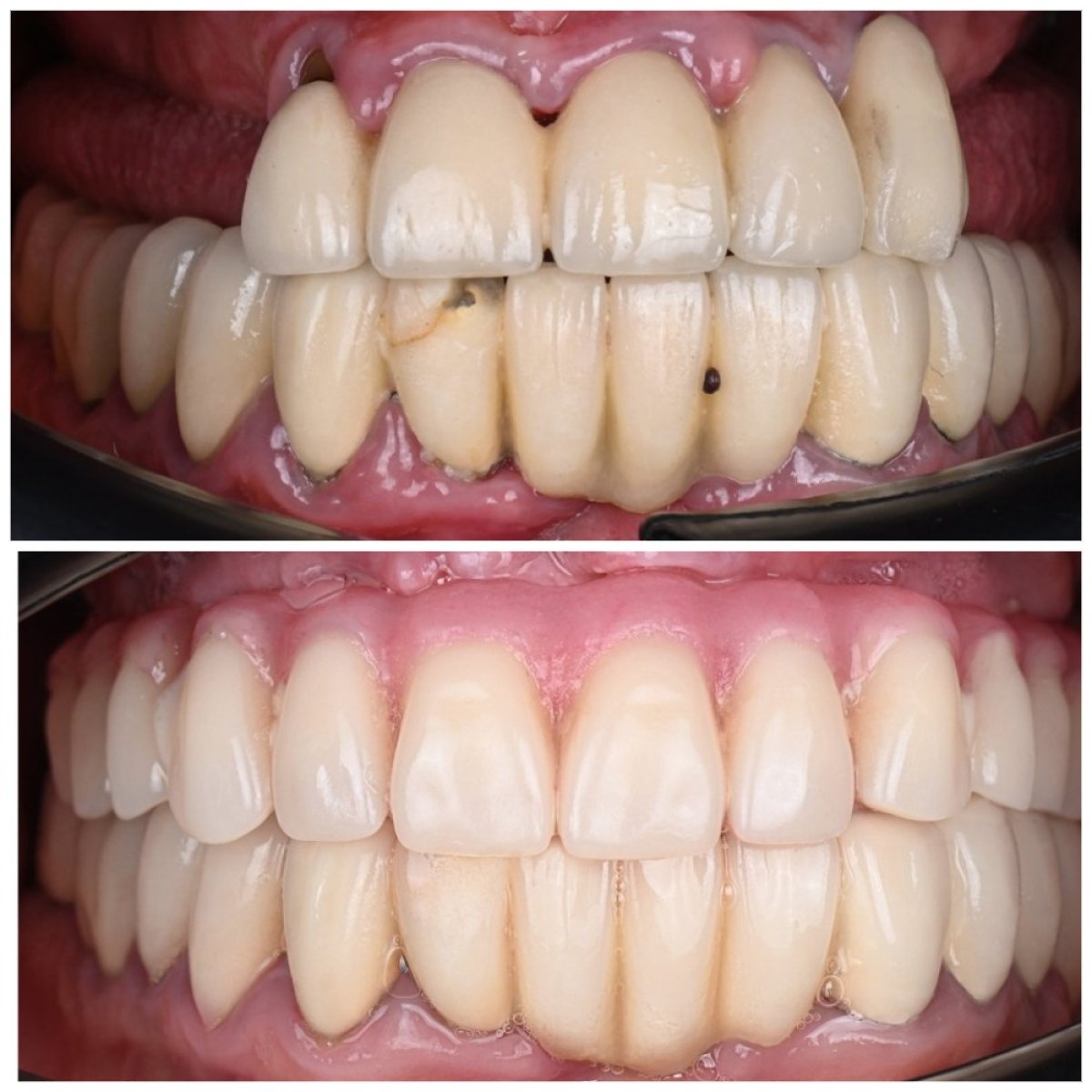 Результат до та після імплантації All-on-4 у YAREMA DENTAL – повне відновлення усмішки