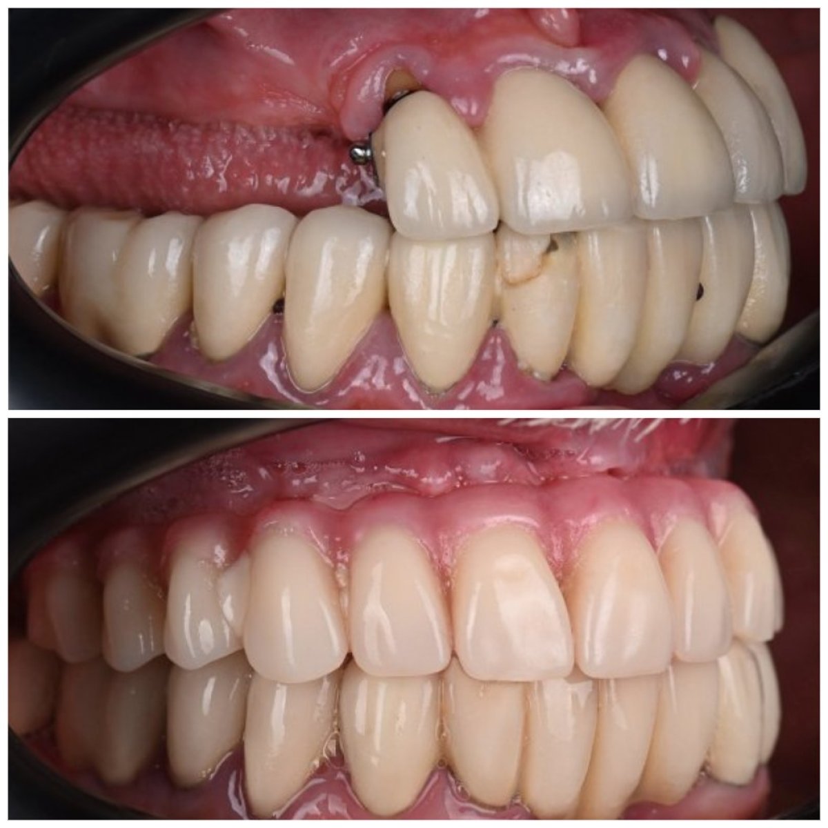 نتيجة قبل وبعد زراعة الأسنان All-on-4 في YAREMA DENTAL – استعادة الابتسامة الكاملة