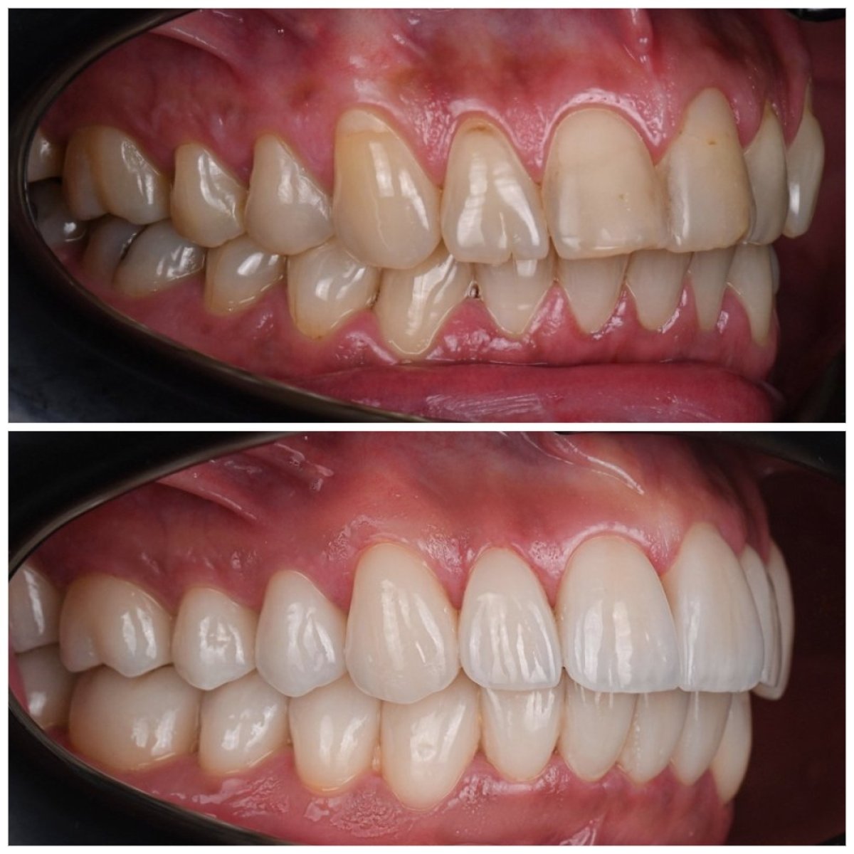 До та після встановлення вініров у YAREMA DENTAL – трансформація посмішки з природним результатом