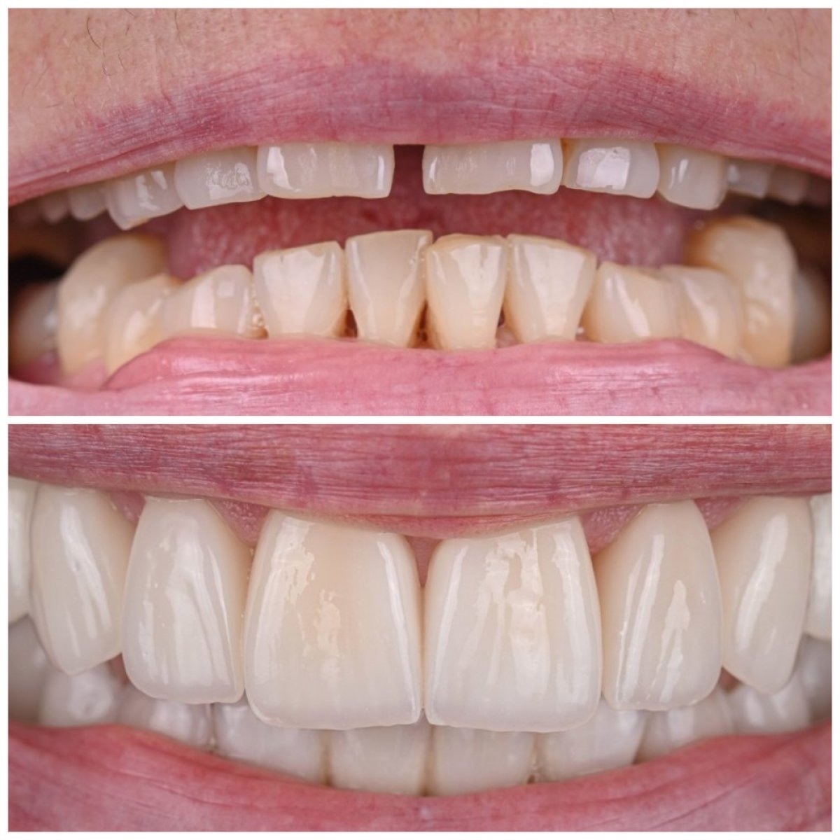 نتائج قبل وبعد عدسات الأسنان في YAREMA DENTAL – ابتسامة طبيعية وجذابة