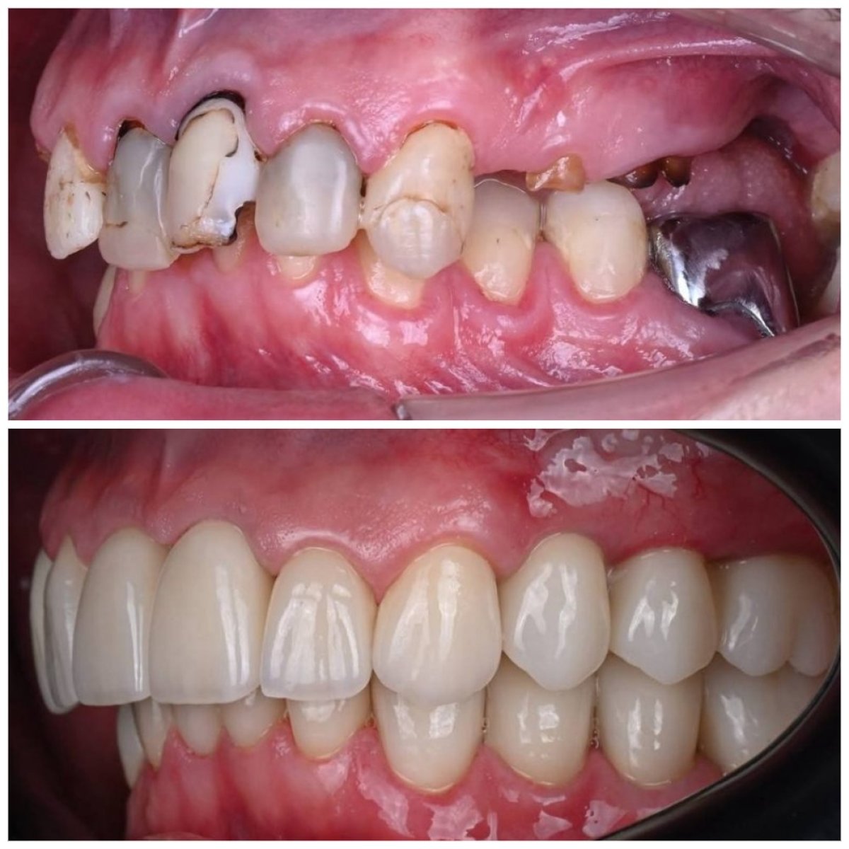Before and after dental implant results at YAREMA DENTAL – restored smile and healthy teeth