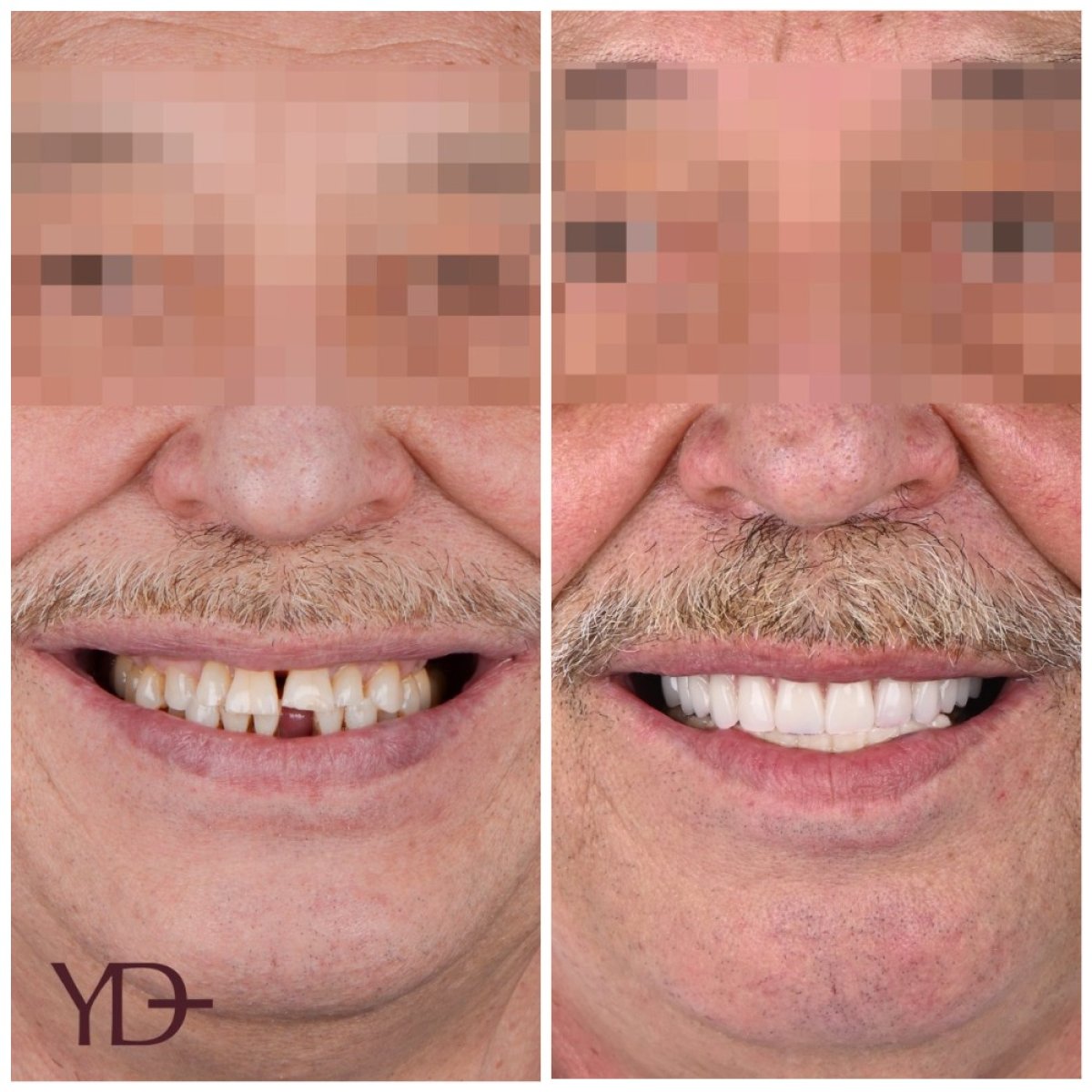 Before and after dental implant results at YAREMA DENTAL – restored smile and missing teeth