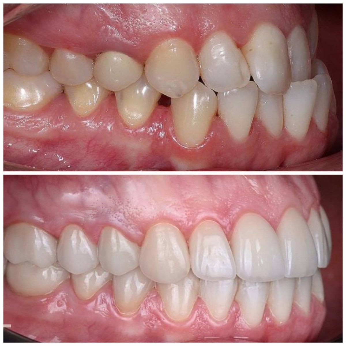 Результаты до и после брекетов в YAREMA DENTAL – выравнивание зубов и улыбки