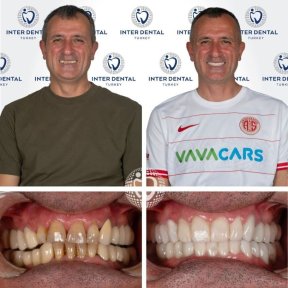 DIO UV (Korea) dental implant installation - photo 6