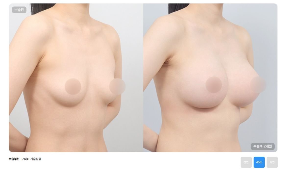 نتائج تكبير الثدي قبل وبعد في AB Plastic Surgery – شكل ممتلئ وطبيعي
