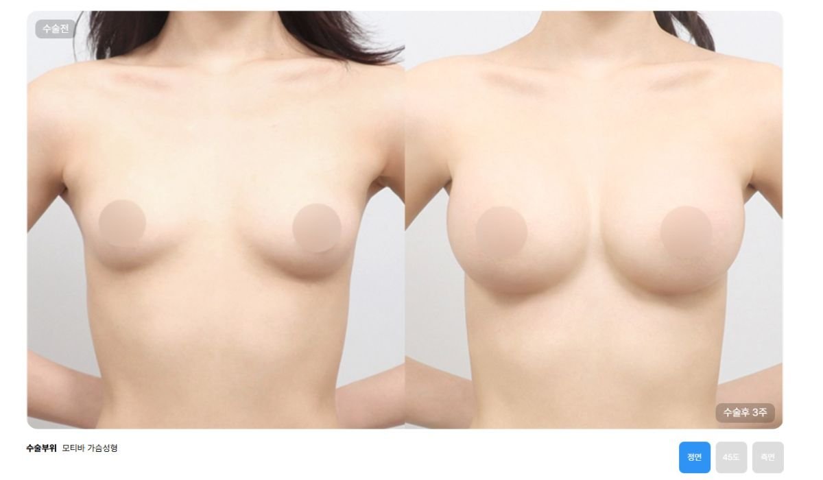 Résultats avant et après augmentation mammaire chez AB Plastic Surgery – volume accru