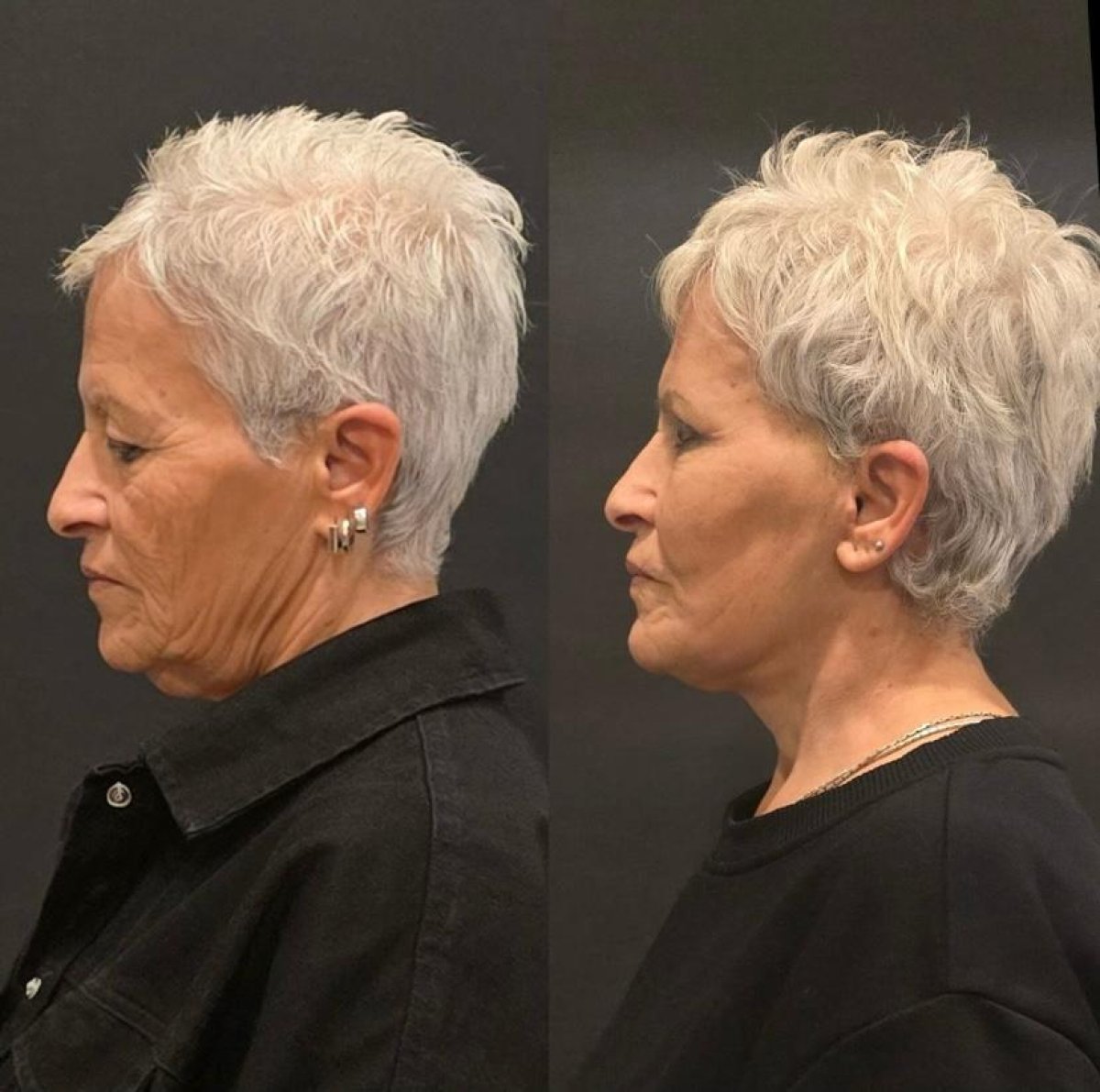 Before and after forehead lift results at Turan Turan Health Group, visible wrinkle reduction