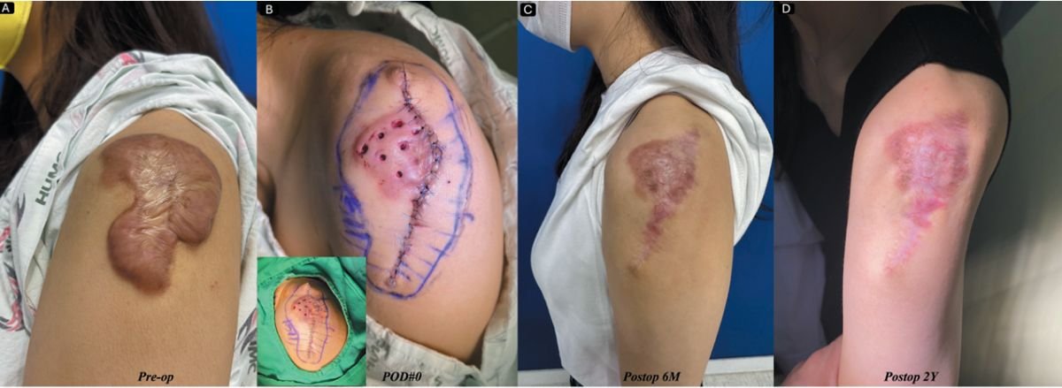 Before and after skin surgery results for keloid removal at Xiamen Humanity Hospital, arm area