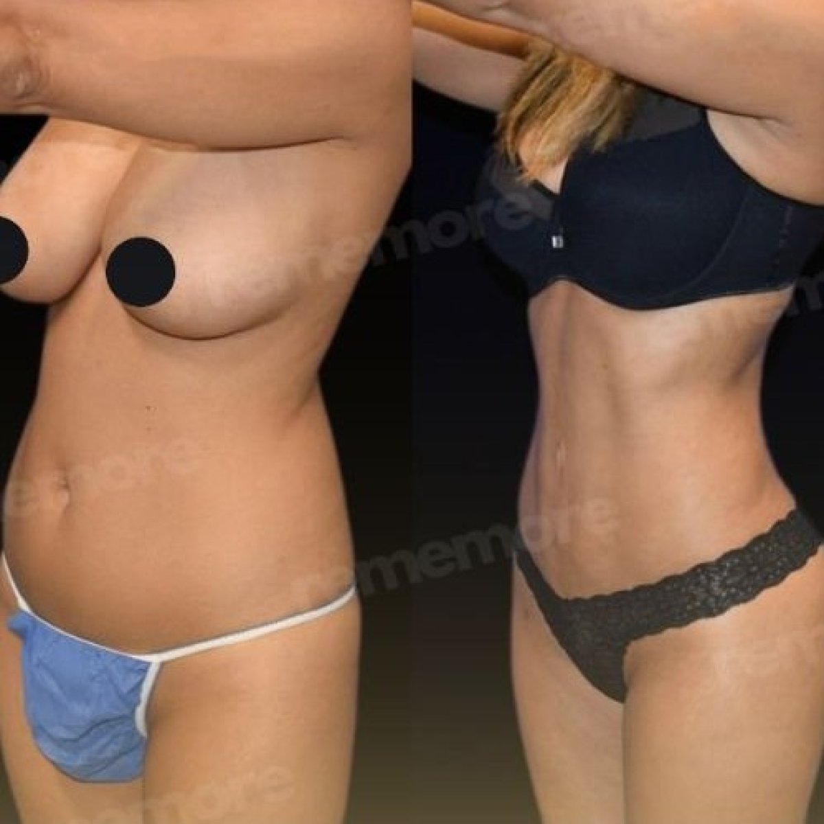 Before and after 360 liposuction results at Memorial Şişli Hospital, improved body contour