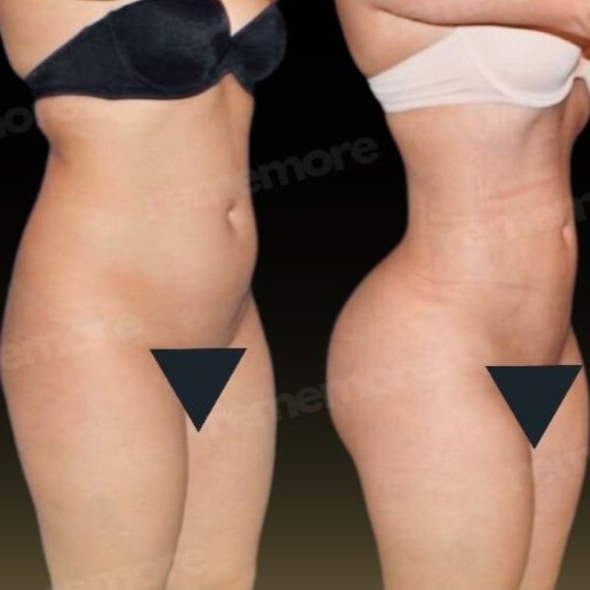 Before and after 360 liposuction results at Memorial Şişli Hospital, improved body contour