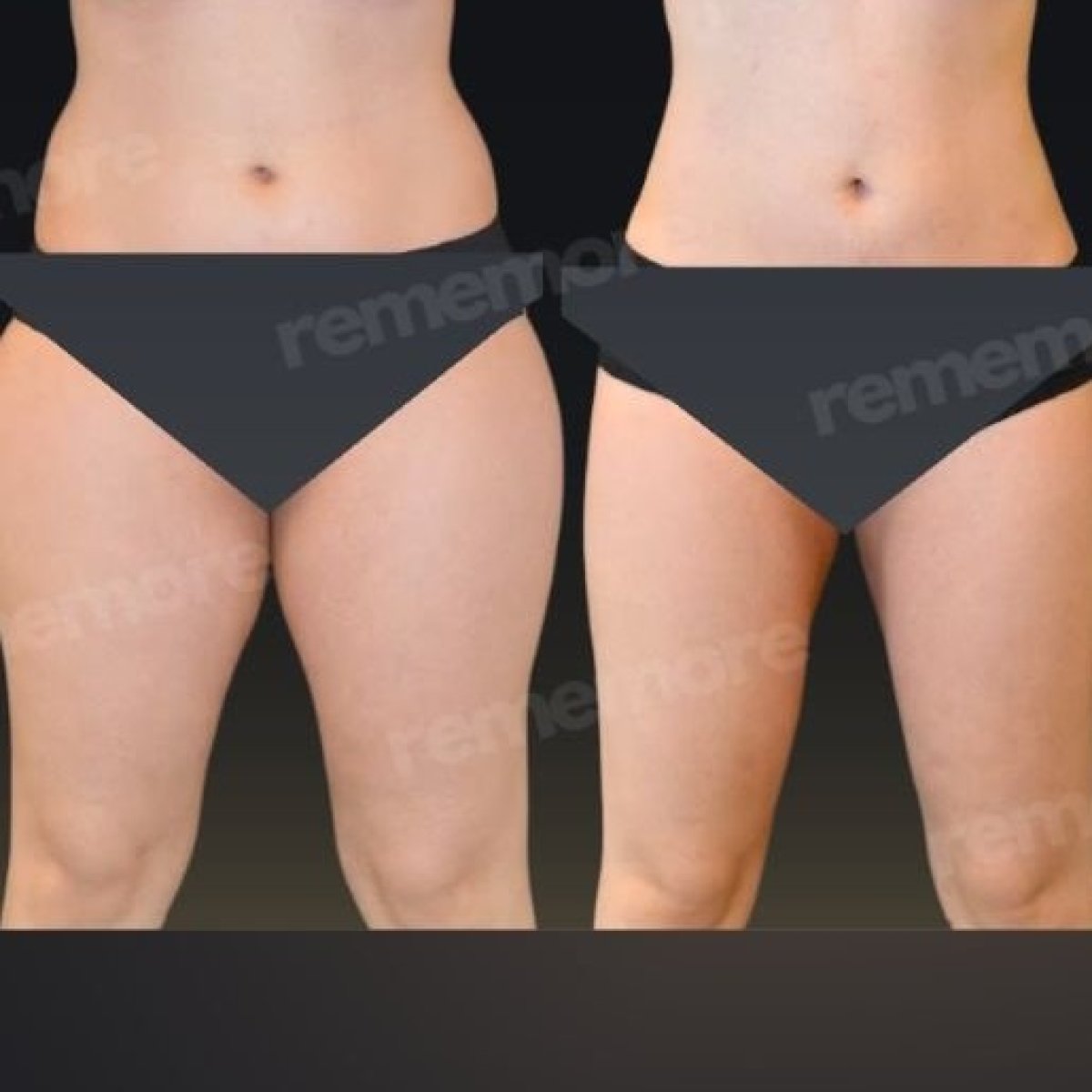 Before and after 360 liposuction results at Memorial Şişli Hospital, body contour improvement
