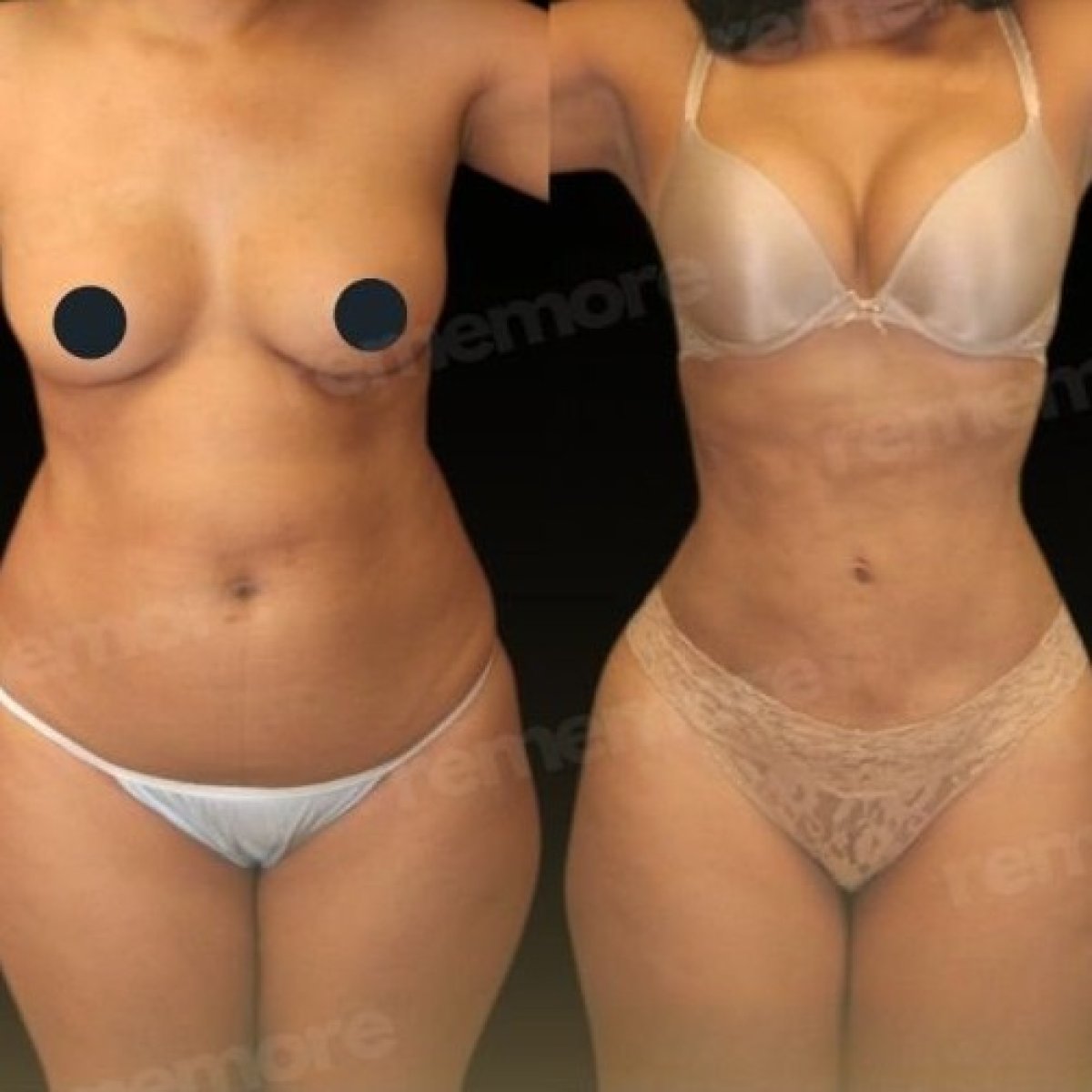 Before and after 360 liposuction results at Memorial Şişli Hospital, improved body contour