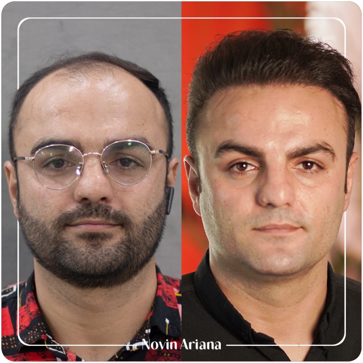 نتائج زراعة الشعر قبل وبعد في عيادة Novin Ariana – استعادة خط الشعر للمريض