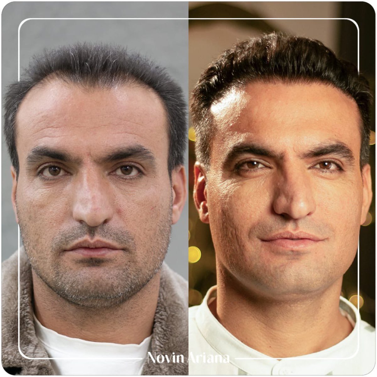 نتيجة زراعة الشعر قبل وبعد في عيادة Novin Ariana – استعادة خط الشعر الممتلئ