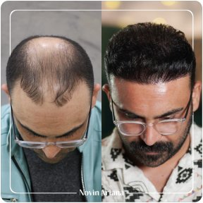 Ariana Basic Hair transplant - photo 4