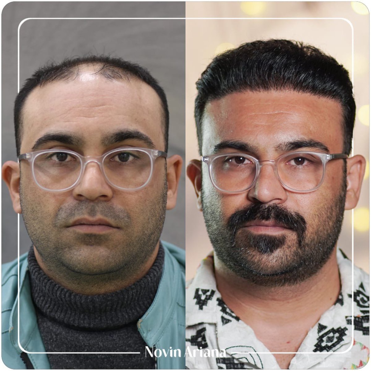 نتائج زراعة الشعر قبل وبعد في عيادة Novin Ariana – استعادة خط الشعر للمريض