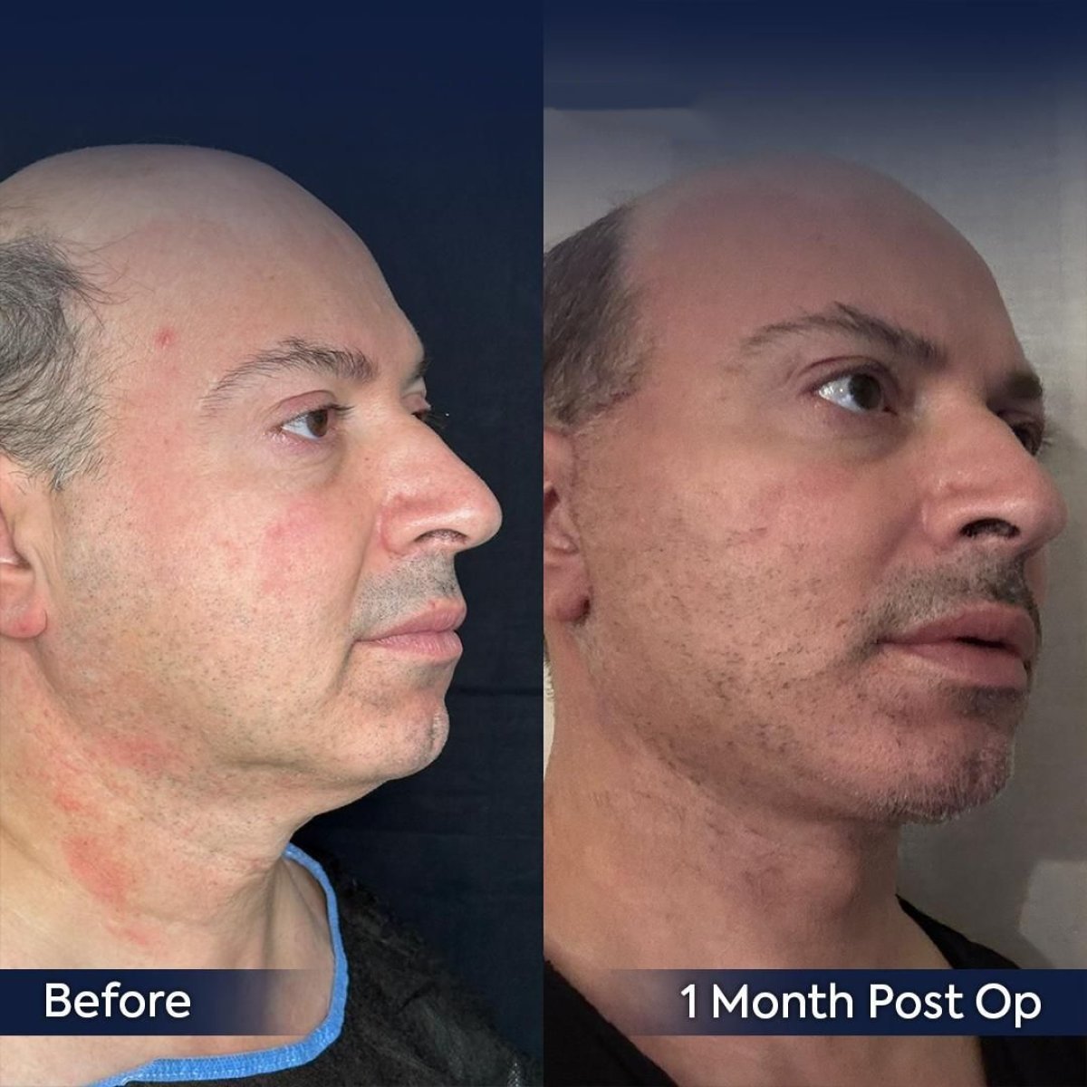 Resultados de lifting endoscópico facial antes y después en Dr. Safa Manav Clinic, elevación visible