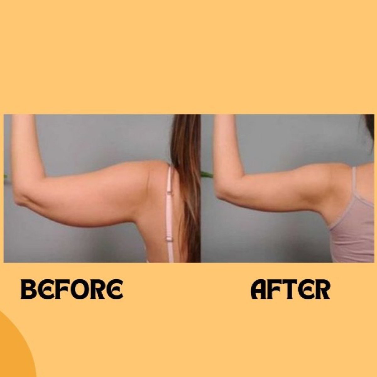 Before and after upper arm liposuction results at ID Clinic Bangkok, slimmer arm contour