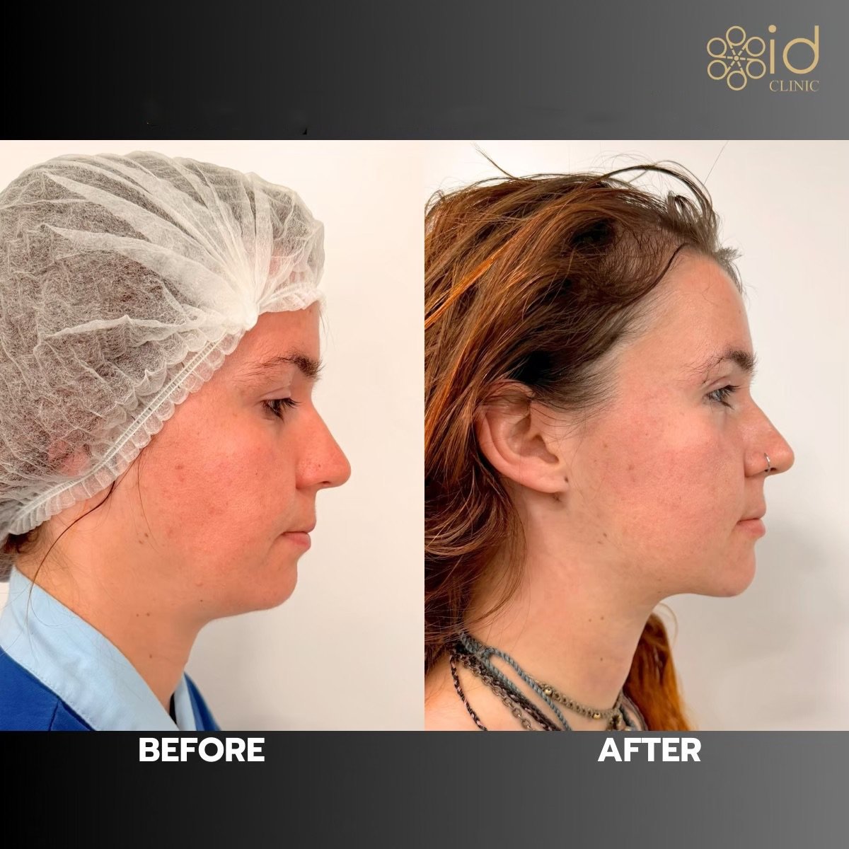 Before and after chin liposuction results at ID Clinic Bangkok, improved jawline contour