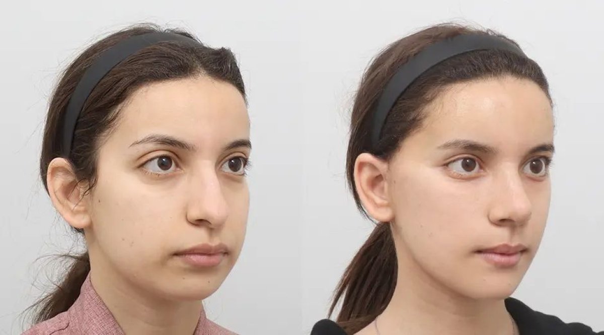 نتائج قبل وبعد Fox Eye Lift في AB Plastic Surgery – تحسين واضح في محيط العين