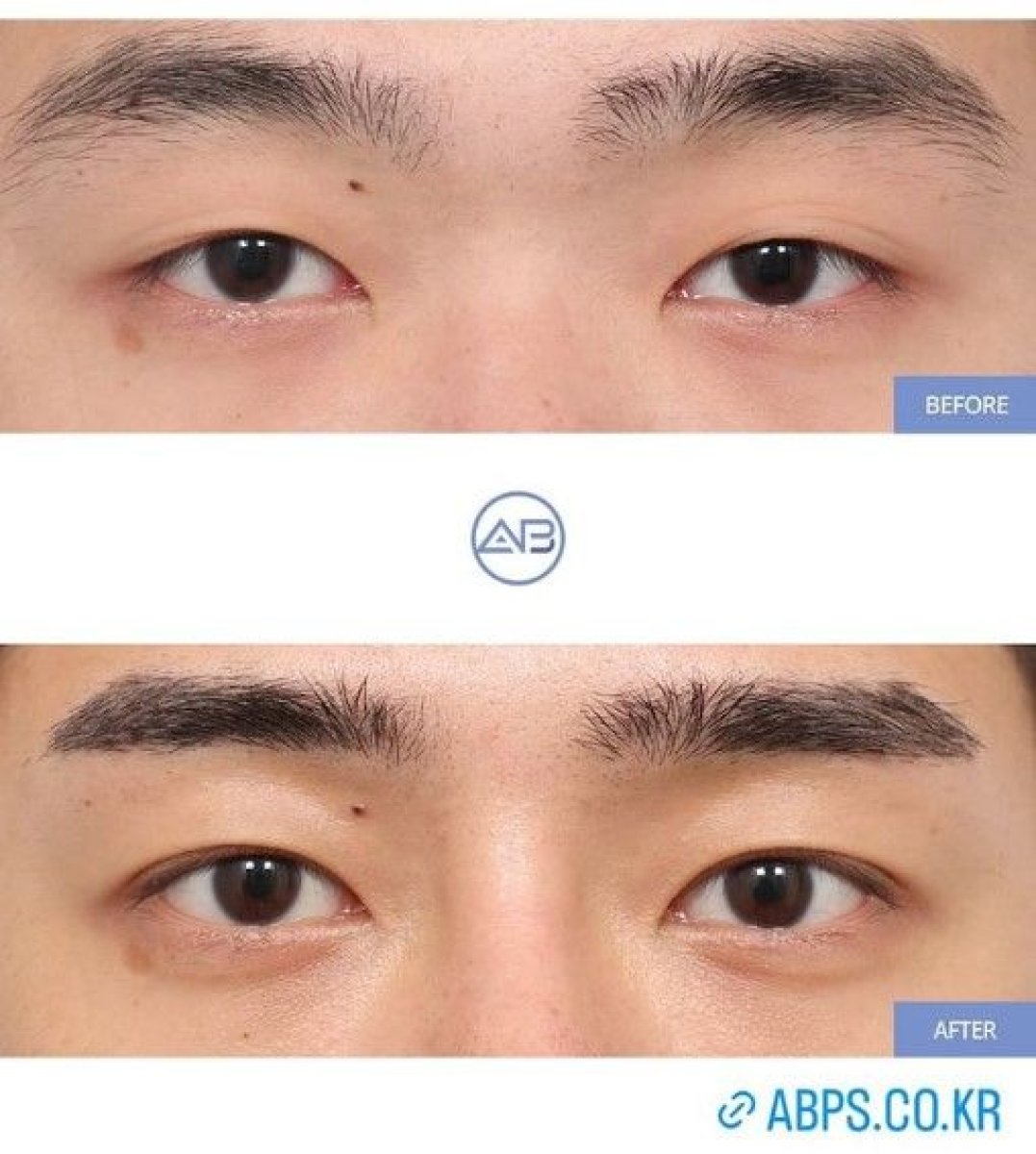Before and after blepharoplasty results at AB Plastic Surgery, eyelid correction improvement
