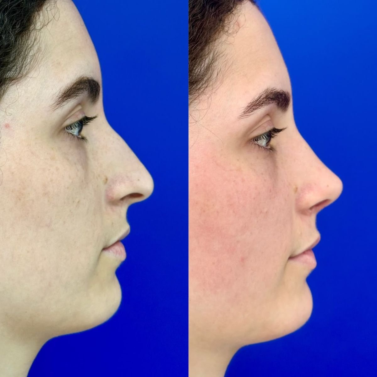 Efekty przed i po rhinoplastyce w Intrarat Hospital, poprawiony kształt nosa