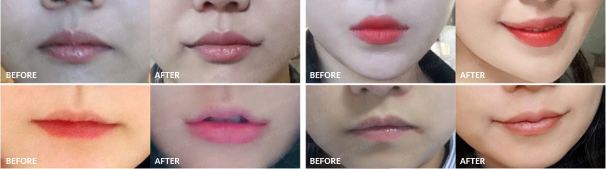 Cheiloplasty before and after results – improved lip shape and contour after surgery