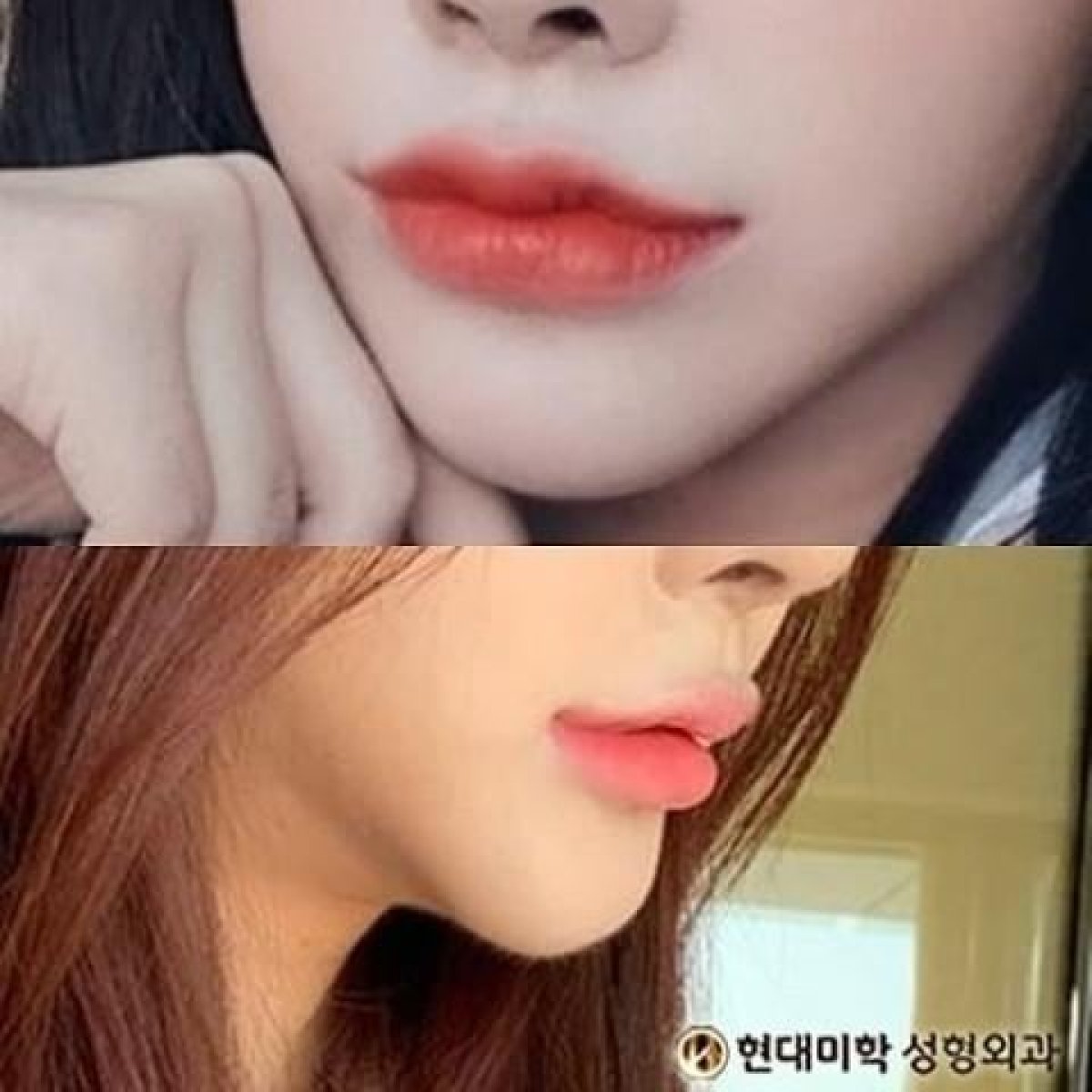 Before and after lip lift results, enhanced lip contour and volume at the clinic