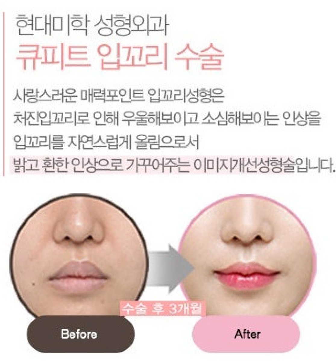 Before and after lip lift results – enhanced lip contour and fuller appearance after procedure