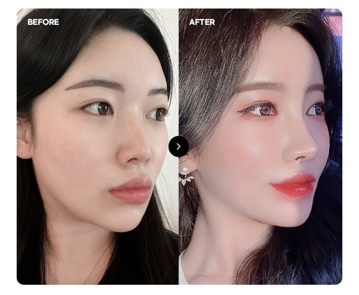 Facial fat transfer before and after results – enhanced cheek and jawline contour