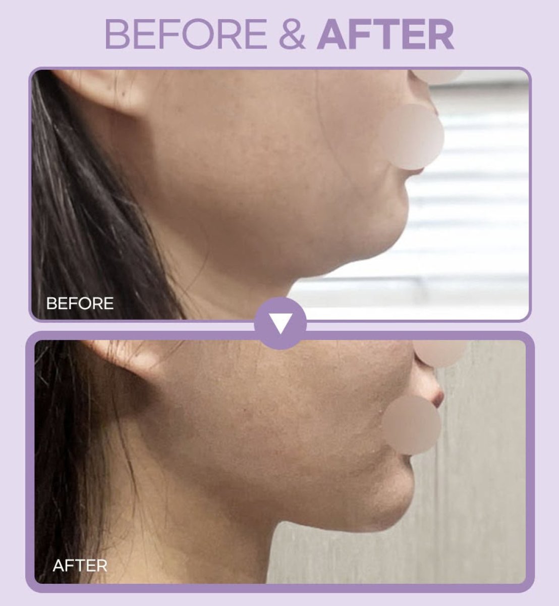 Before and after double chin liposuction results – improved jawline contour visible