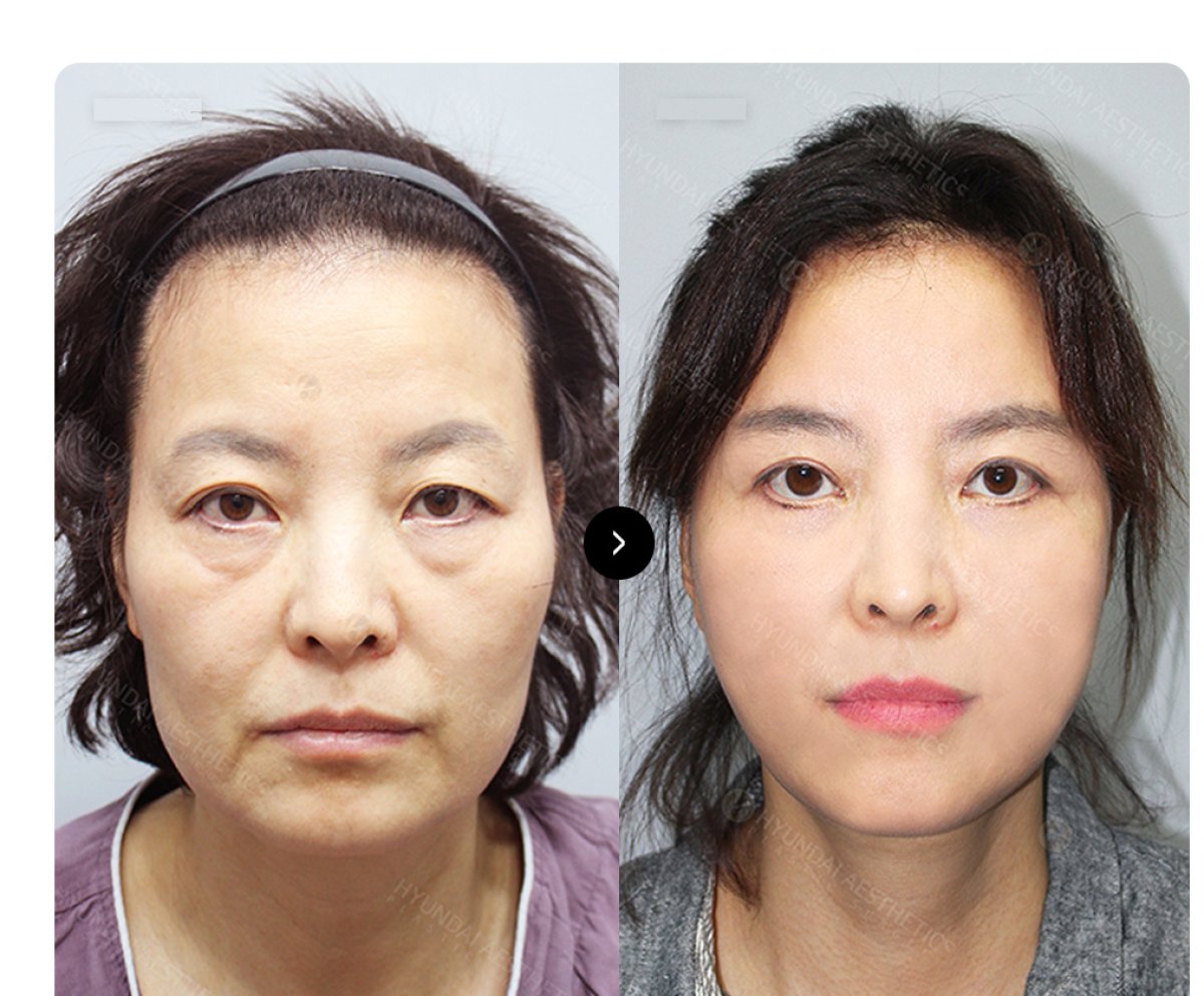 Результаты до и после SMAS-лифтинга в Hyundai Aesthetics – омоложение лица