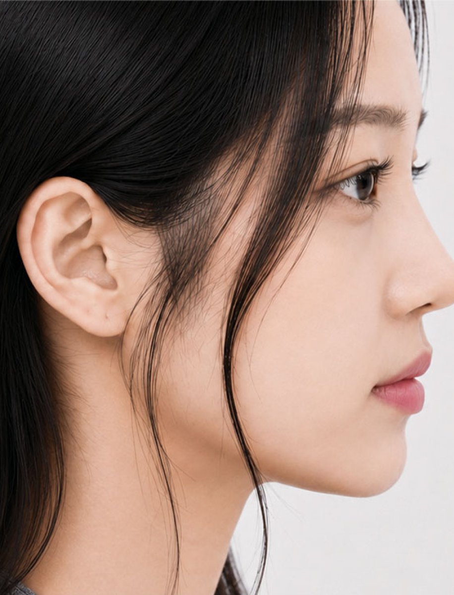 Rhinoplasty result side profile, refined nose shape after nose job procedure