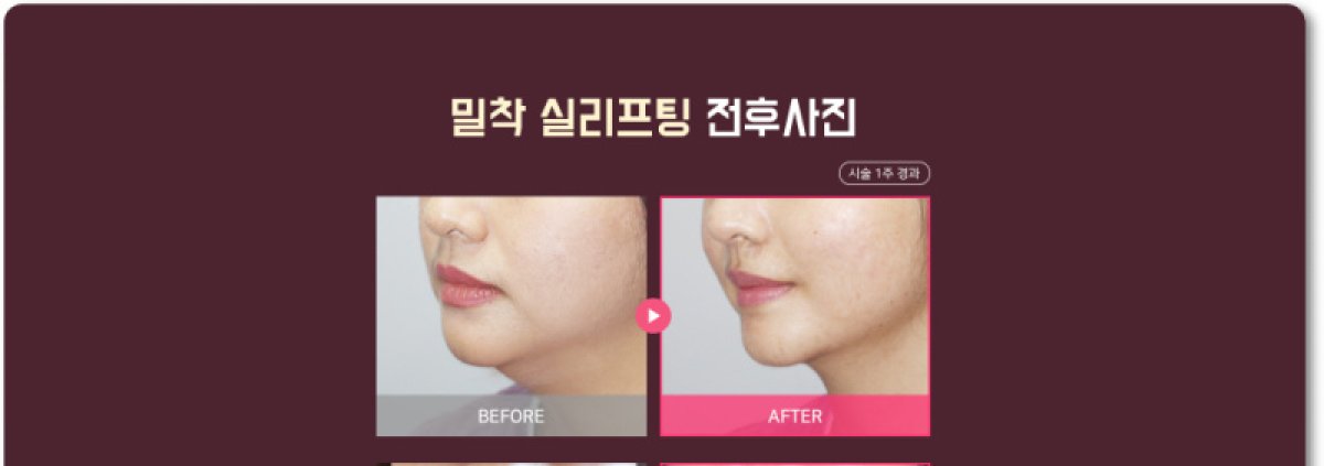 Before and after neck lift results – visible jawline and neck contour improvement