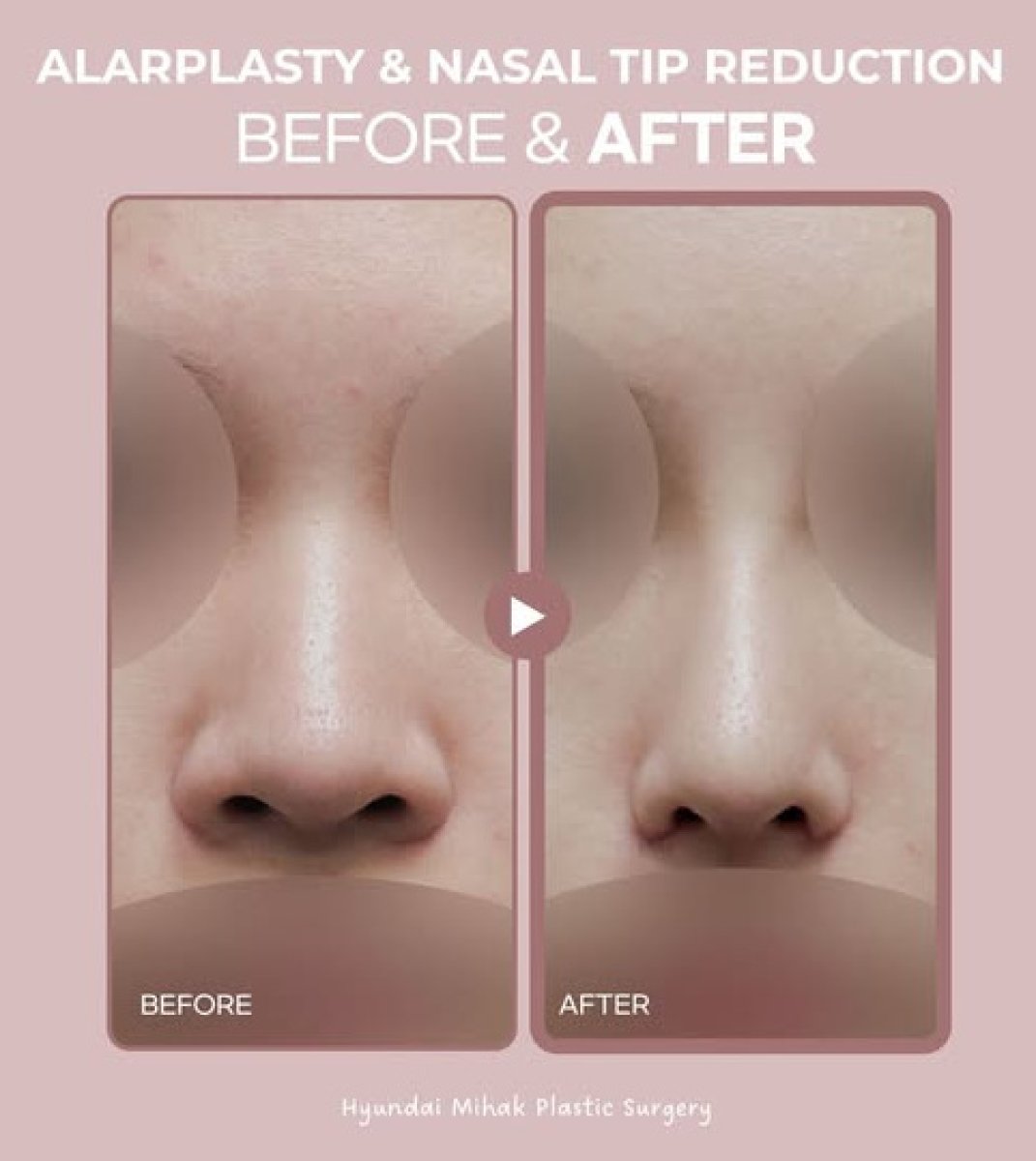 Before and after alarplasty and nasal tip reduction results at Hyundai Mihak Plastic Surgery