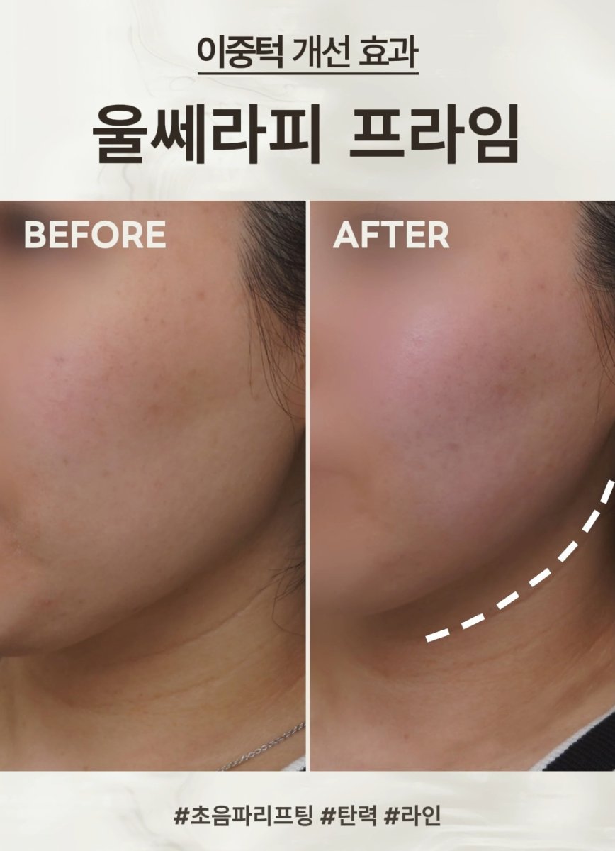Ultherapy before and after result – improved jawline and skin tightening at clinic